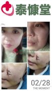 古方中药疤痕修复:美与爱传承—武汉泰慷堂医药科技有限公司